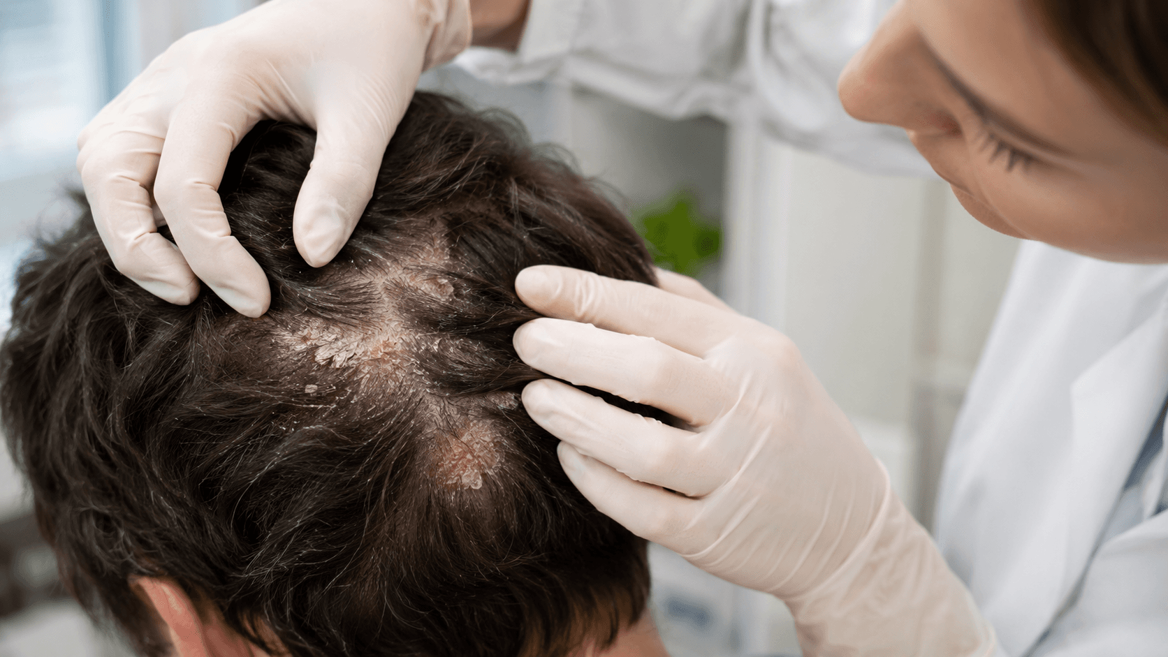 Imagen de apoyo para Psoriasis en el cuero cabelludo: placas, descamación y cuidados